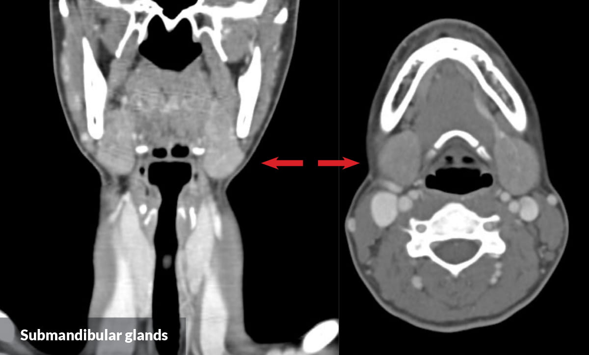 IgG4ward_Academy_Chapter 5_Ln 1_06_MRI_Submandibular Glands_TX_1200x724pxl.jpg